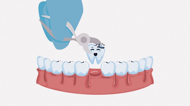虫歯を治療する歯科医の手術映像