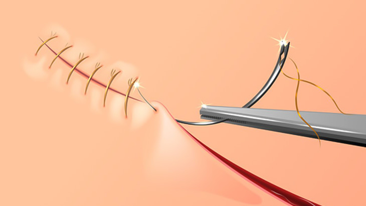 【閲覧注意】医者「ぐちゃぐちゃになった腕を縫合しますねー」（画像＋動画）