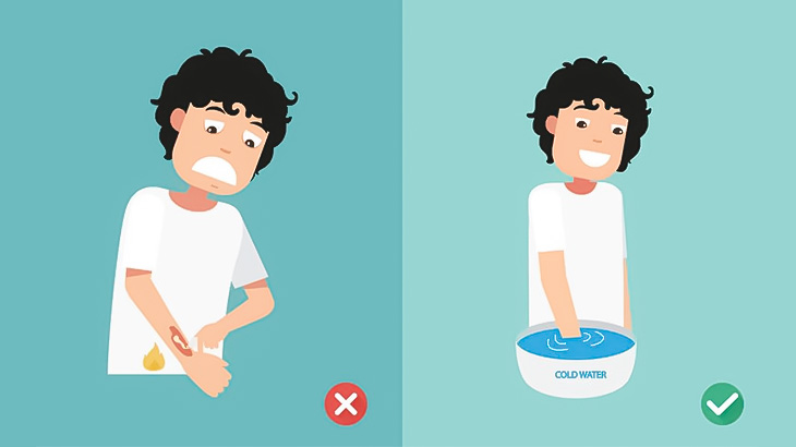 【微閲覧注意】Youtuberさん、腕を大やけどしてしまう（動画）