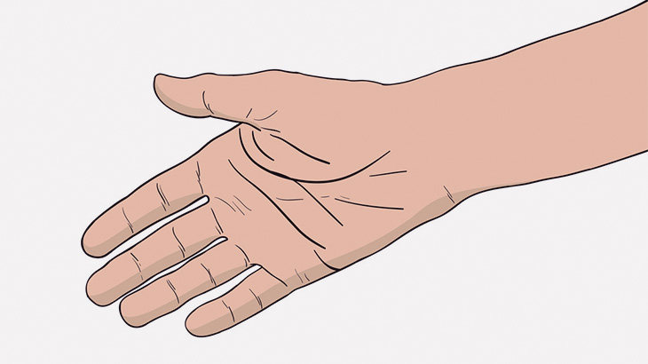 【閲覧注意】手のひらの皮膚剥がれちゃったｗｗｗｗ（動画）