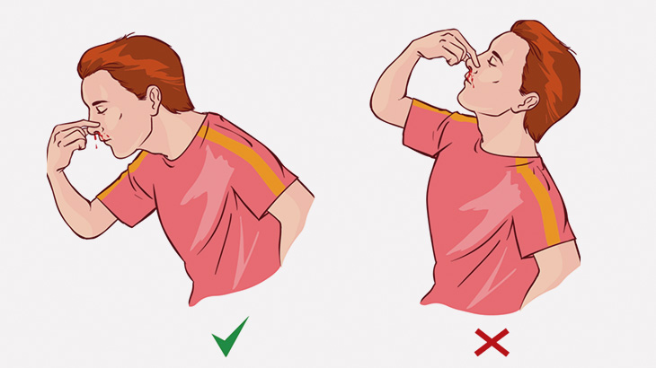 【微閲覧注意】鼻血が止まらなかった男の体からこんなものが引き抜かれる･･･（画像）