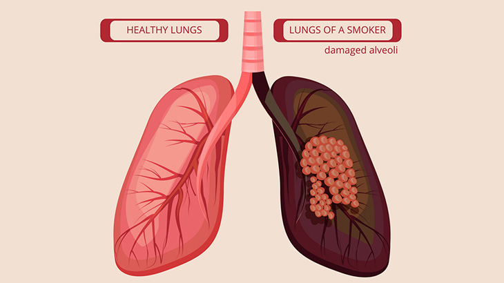 喫煙者だった人間の肺、黒いにも程がある（動画）
