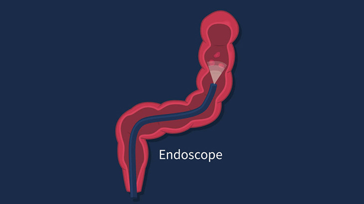 男の肛門に内視鏡カメラを突っ込む → キュウリを摘出（動画）