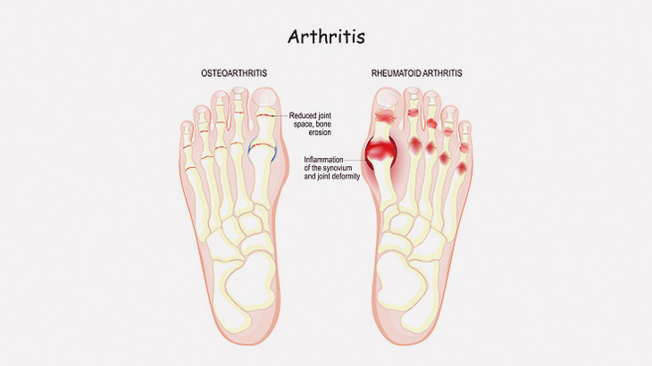 【閲覧注意】関節リウマチで変形した足の指の手術ビフォーアフター（画像）