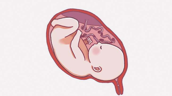 帝王切開で羊膜に包まれたまま産まれてくる赤ちゃん（動画）