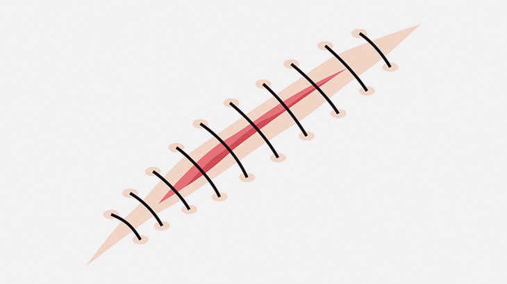 針の縫合に代わる、新たな医療技術（動画）