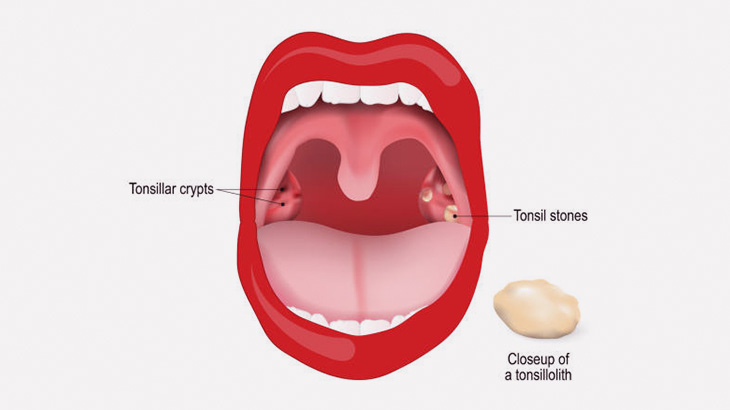 【微閲覧注意】扁桃腺を棒で押す → 臭い玉が飛び出る（動画）