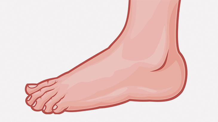 【閲覧注意】この足の踵、腐りつつある･･･（動画）