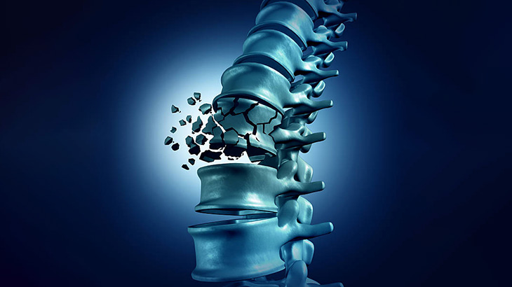 【閲覧注意】背骨を骨折した男性の手術（動画）