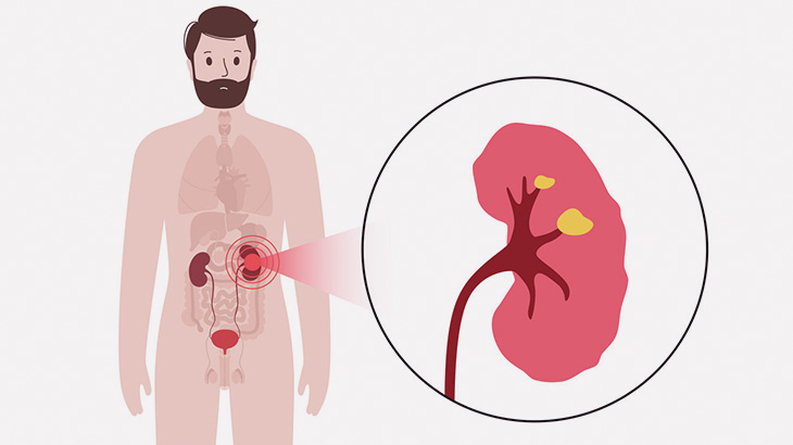 【閲覧注意】とある人間から摘出された腎臓、ヤバいことになってた･･･（画像）