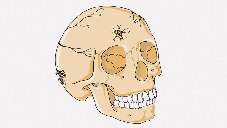 【閲覧注意】バイク事故で頭を負傷した女性のビフォーアフター（画像）