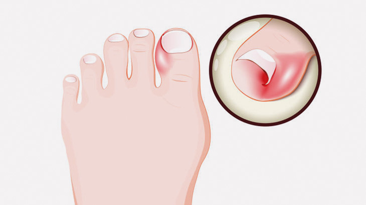 【閲覧注意】足の指の巻き爪を切除する手術（動画）