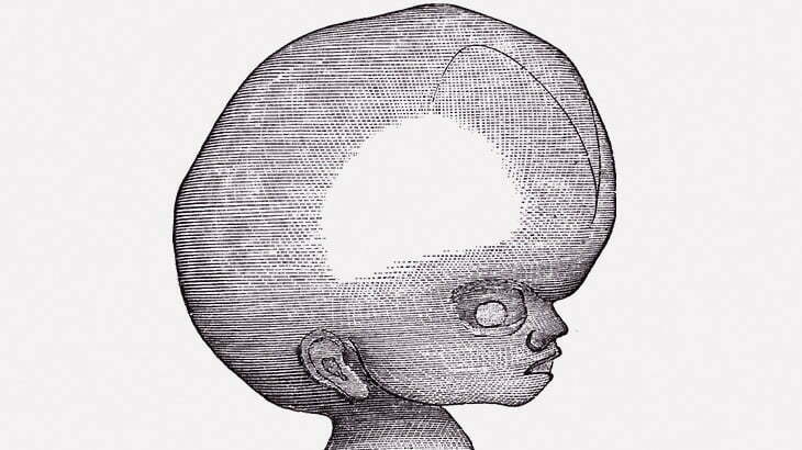 【閲覧注意】この赤ちゃんの頭、ヤバい･･･（画像）