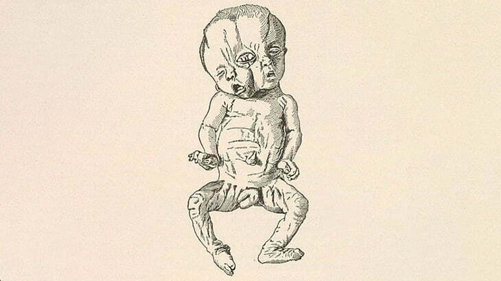 【閲覧注意】顔が「重複」した状態で生まれてきてしまった子供たち（画像）