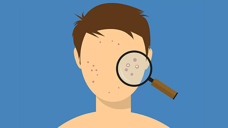 ちょっと切り開いた男性の頬を押す → 粉瘤ピュッピュッ（動画）