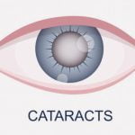 【閲覧注意】眼球の濁った水晶体を取り除き人工レンズに入れ替える手術（動画）