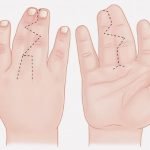 指がくっついた状態で産まれてきてしまう先天性疾患「合指症」（画像）