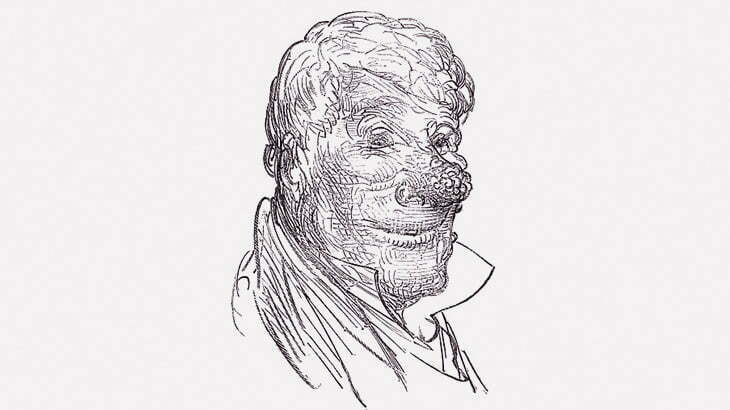 【閲覧注意】この男性の鼻、ヤバすぎ･･･（画像）