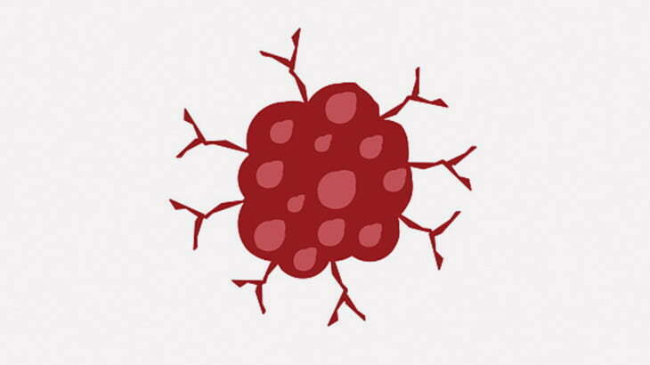 【閲覧注意】男「お腹に出来た肉腫を切除してもらいました」（画像）