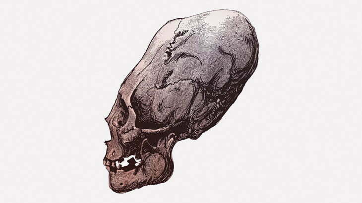 【閲覧注意】医師「頭の形おかしいので治しましょうねー」（画像）