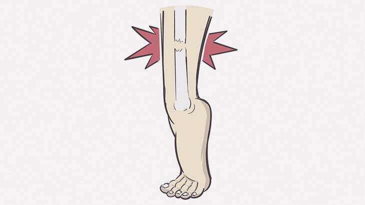 【閲覧注意】足折れちゃった男、なぜか立ち上がろうと必死･･･（動画）