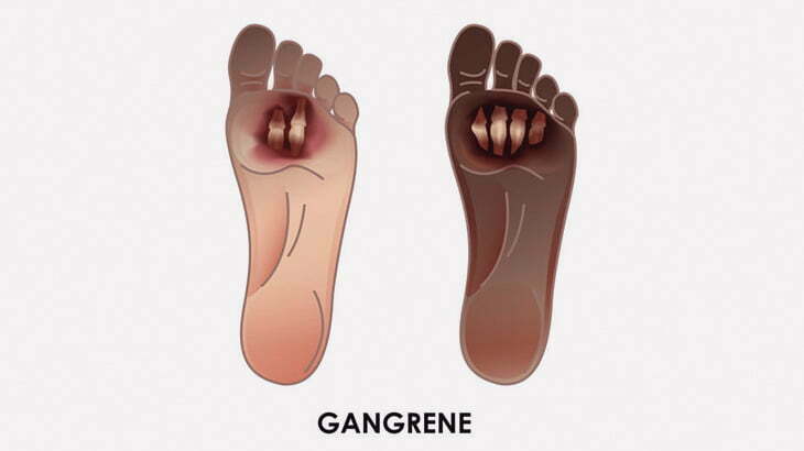 糖尿病で腐ってしまった男性の足、手術でこうなる･･･