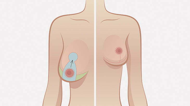 【閲覧注意】私のオッパイ垂れすぎだったから手術してもらった（画像）