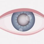 【閲覧注意】白内障で白く濁った目をキレイにする手術（動画）