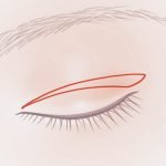 【閲覧注意】加齢による目のたるみを治す手術（動画）
