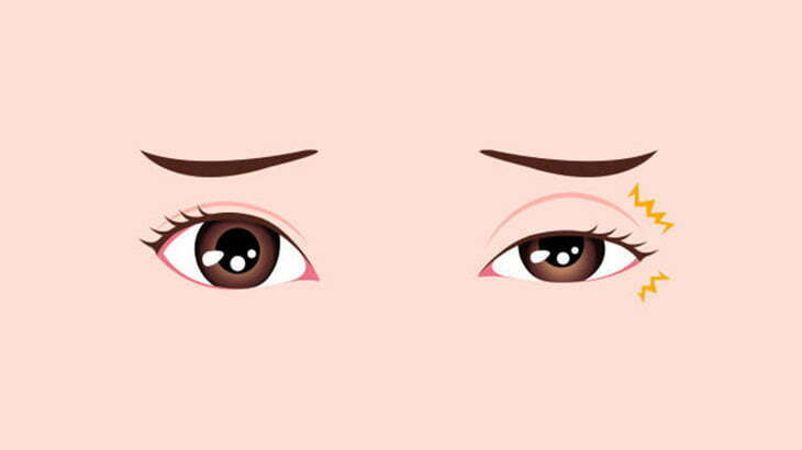 【閲覧注意】まぶたの裏に出来た粉瘤を潰す手術（動画）