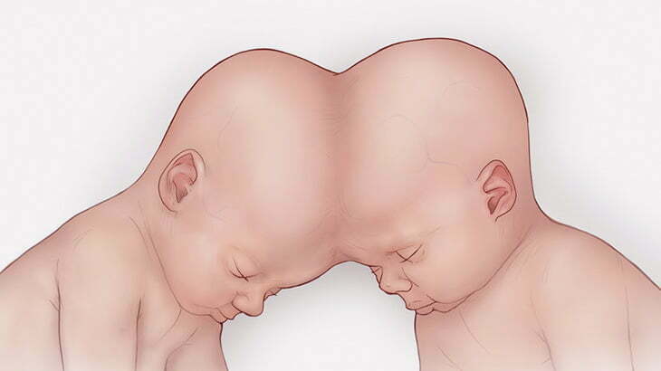 【閲覧注意】頭がくっついたまま大人になった結合双生児「ロリとジョージ」（動画）