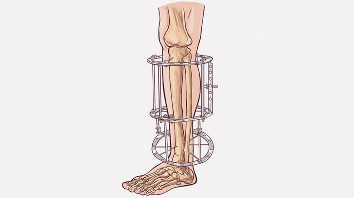 黒人男性「骨延長手術で１６８ｃｍから１８３ｃｍにしてもらったｗｗｗ」（動画）