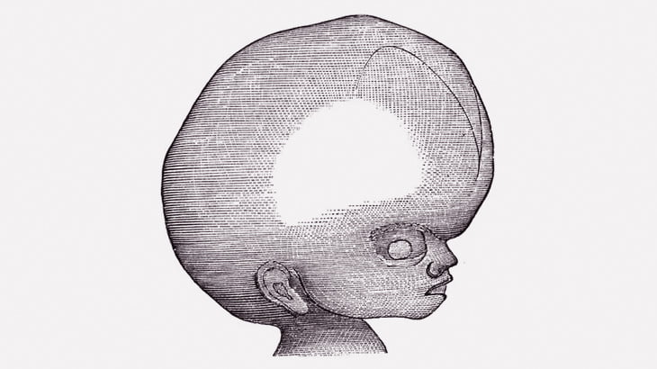 【閲覧注意】この赤ちゃんの頭、デカすぎる･･･（動画）