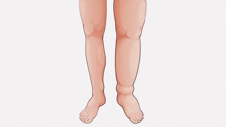 【閲覧注意】この男の左足、異様にデカい･･･（動画）