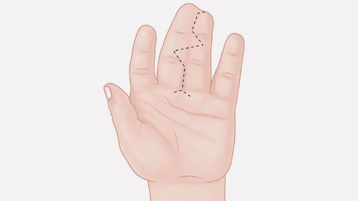 母親「うちの子、中指と薬指がくっついてるんだよね」（動画）