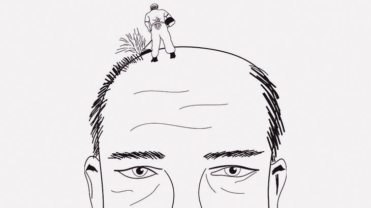 ハゲてしまった男「もう･･･剃った方がいいですかね･･･？」（画像）