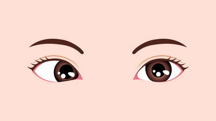 【閲覧注意】「寄り目」の眼球を正常な位置に戻す手術（動画）