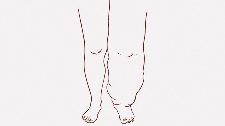 【閲覧注意】象皮病で膨れ上がった足の肉を切除する手術（画像）