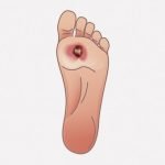 【閲覧注意】足裏に出来た粉瘤を摘出する手術（動画）