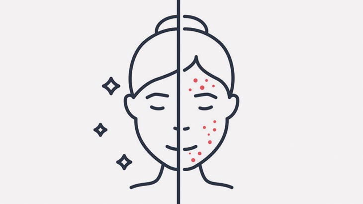 【閲覧注意】ニキビをピンセットでひたすら引っこ抜く手術（動画）