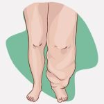 【閲覧注意】「リンパ浮腫」を患った男の両脚、とんでもないことに･･･（動画）