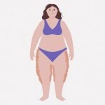 「脂肪浮腫」を発症した女性、太ももがこんなことになってしまう･･･（動画）