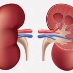【閲覧注意】腎臓に嚢胞がたくさんできてしまう「多発性嚢胞腎」（動画）