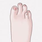 足の薬指だけ短くなってしまう「中足骨短縮症」（動画）