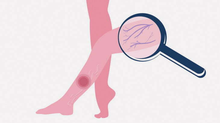 血管がクモの巣のように浮き出てしまう「スパイダースキン」（動画）