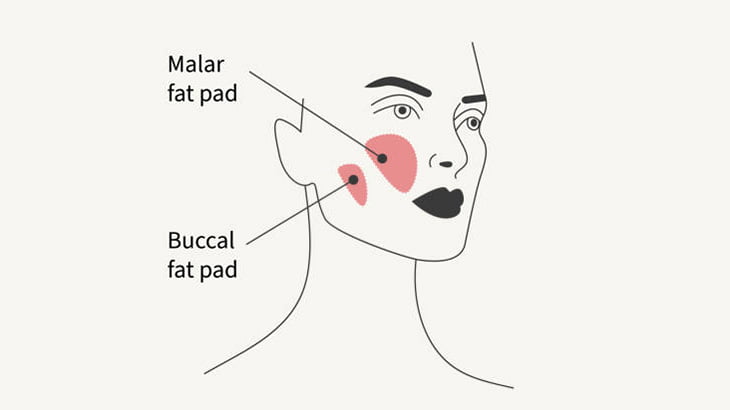 頬の脂肪を除去して小顔になれる「バッカルファット」除去手術（動画）