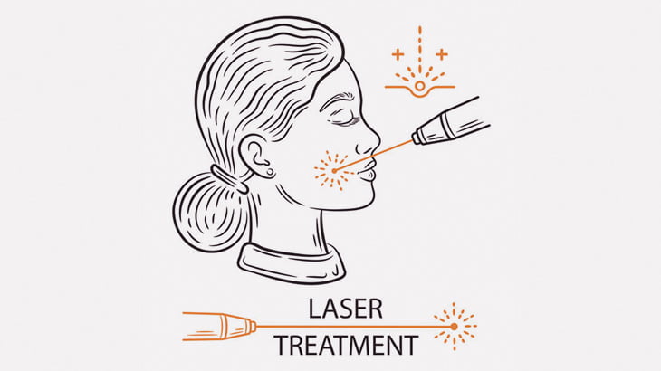 顔の皮膚に小さな点の穴を開けて皮膚の再生を促すフラクショナルレーザー治療（動画）