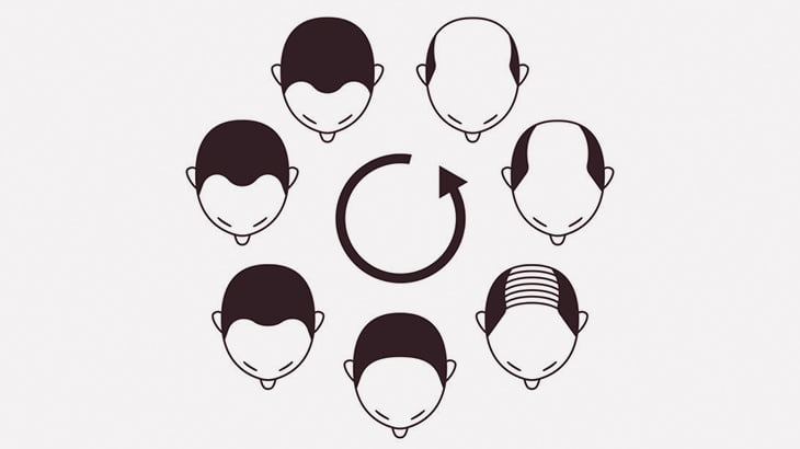 ハゲてしまった男たちの頭に毛根を移植する手術（動画）