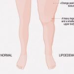 リンパ浮腫で膨れ上がった女性の足、圧迫療法でここまで治すことができる（動画）