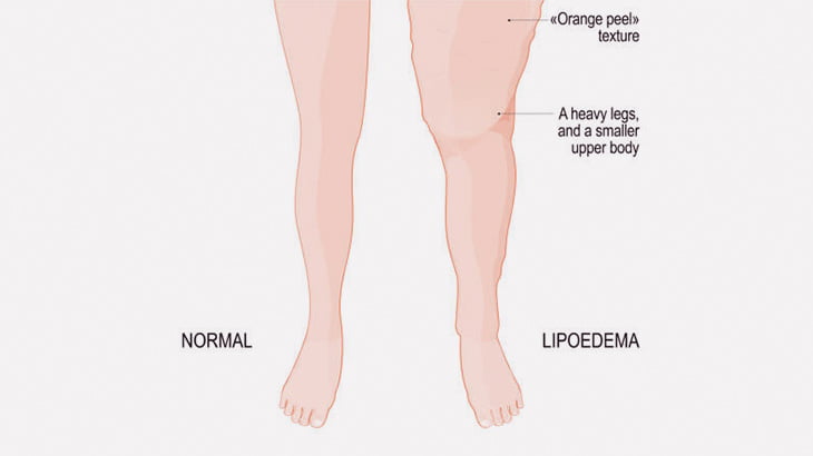 リンパ浮腫で膨れ上がった女性の足、圧迫療法でここまで治すことができる（動画）